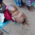 Malnutrition enfantine