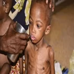 Malnutrition enfantine